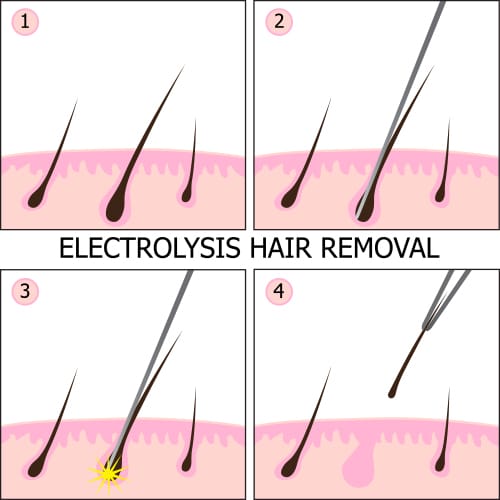 Electrolysis Hair Removal Illustration