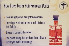 How Does Laser Work
